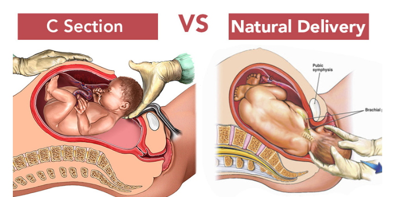 c-section-vs-normal-delivery